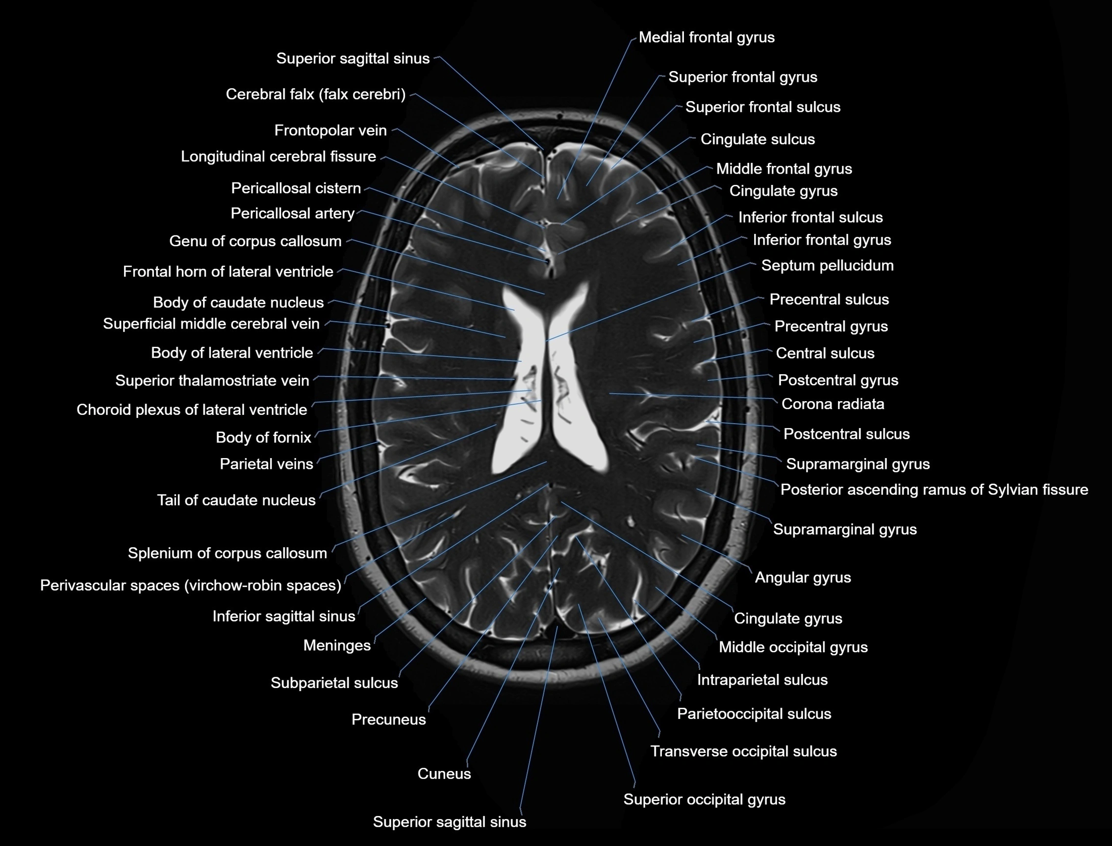 MRI Brain axial cross sectional radiology anatomy 3T image  -img-00001-00035.webp
